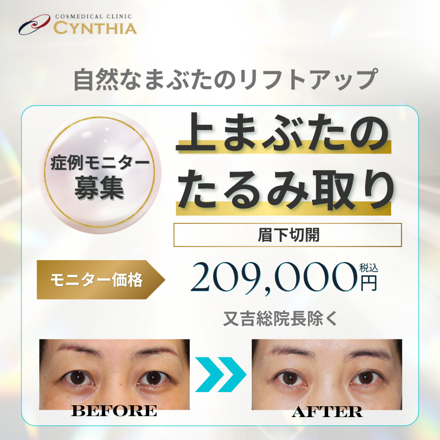 上まぶたのたるみ取